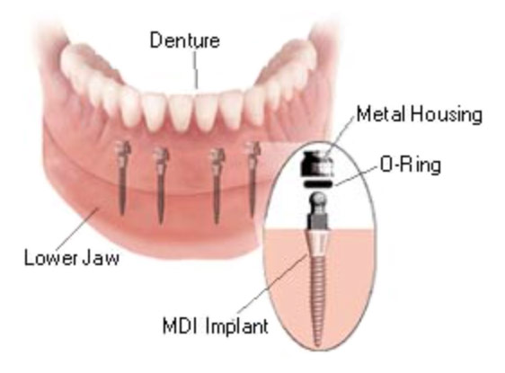 Hauge Dental Care Mini Dental Implants