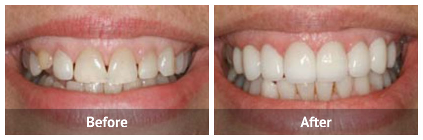 Hauge Dental Care Porcelain Veneers